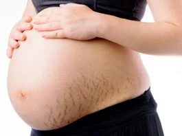 Cum sa previi aparitia vergeturilor in timpul sarcinii? Ce crema a facut minuni in cazul meu