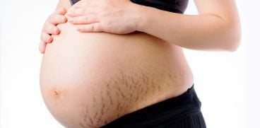 Cum sa previi aparitia vergeturilor in timpul sarcinii? Ce crema a facut minuni in cazul meu