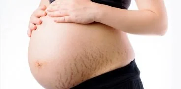 Cum sa previi aparitia vergeturilor in timpul sarcinii? Ce crema a facut minuni in cazul meu