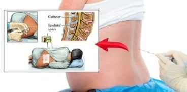 Anestezia epidurala – cum se face si in ce cazuri nu este indicata! Informatii putin cunoscute despre riscuri | Demamici.ro