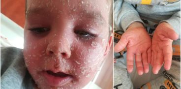 Impreuna pentru Denis! Baietelul a ajuns sa arate asa din cauza tratamentului administrat gresit, in Romania! I-au fost date antibiotice, desi nu era cazul!