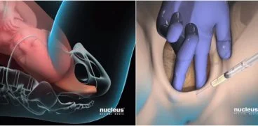 Epiziotomia – taierea perineului in timpul nasterii vaginale! Cum se face si cum poate fi evitata VIDEO | Demamici.ro