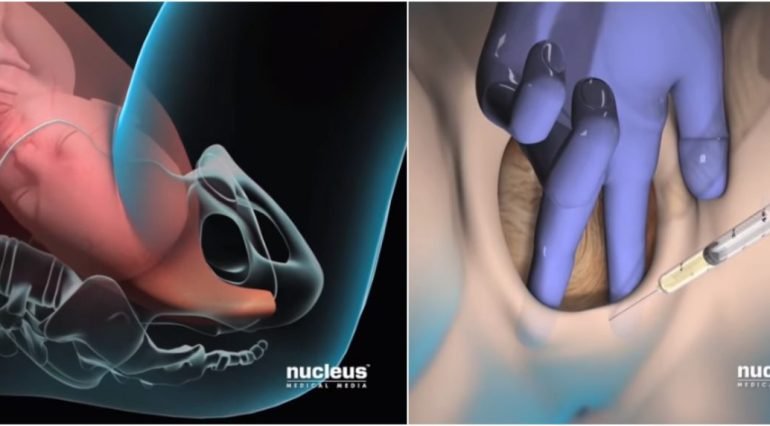 Epiziotomia - taierea perineului in timpul nasterii vaginale! Cum se face si cum poate fi evitata VIDEO | Demamici.ro