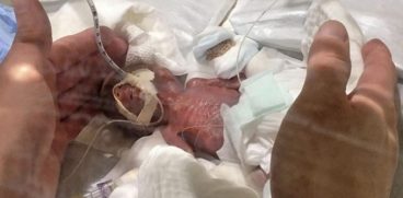 Cel mai mic bebelus din lume a avut la nastere 268 de grame. Cum arata acum baietelul | Demamici.ro