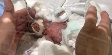 Cel mai mic bebelus din lume a avut la nastere 268 de grame. Cum arata acum baietelul | Demamici.ro