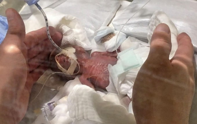 Cel mai mic bebelus din lume a avut la nastere 268 de grame. Cum arata acum baietelul | Demamici.ro