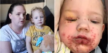 A ajuns in spital dupa ce-a fost pupat. Parintii au facut publice pozele cu chipul copilasului distrus de herpes pentru a trage un semnal de alarma | Demamici.ro