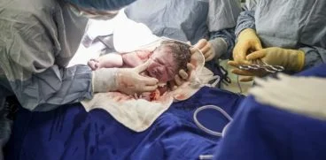 Diferentele dintre copiii nascuti pe cale naturala si cei nascuti prin cezariana. De ce arata diferit | Demamici.ro