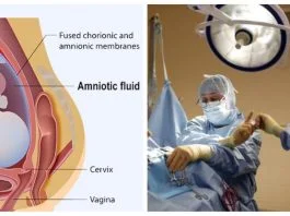 Ce este embolia amniotica – complicatia care a adus-o pe Andreea Balan in pragul mortii | Demamici.ro