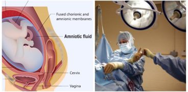 Ce este embolia amniotica – complicatia care a adus-o pe Andreea Balan in pragul mortii | Demamici.ro