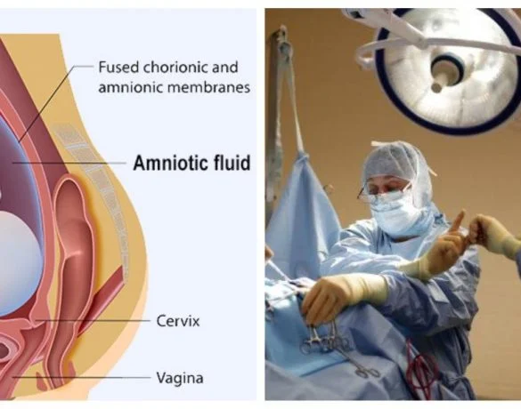 Ce este embolia amniotica – complicatia care a adus-o pe Andreea Balan in pragul mortii | Demamici.ro