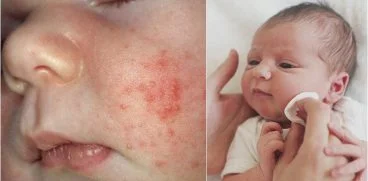 Acneea bebelusului – cauze, tratament si metode de prevenire | Demamici.ro