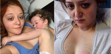 Cum arata sanii afectati de mastita. O mama a facut publica poza din spital | Demamici.ro