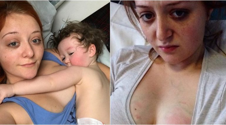 Cum arata un sanii afectati de mastita. O mama a facut publice pozele din spital | Demamici.ro