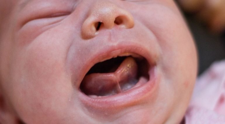 Ce este frenul lingual, cum afecteaza viata bebelusului si cand trebuie operat | Demamici.ro