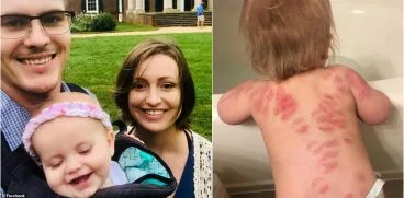 O fetita de 15 luni s-a intors de la gradinita cu 25 de muscaturi pe corp | Demamici.ro