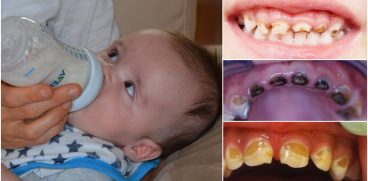 Caria de biberon – cauze, simptome si tratament | Demamici.ro