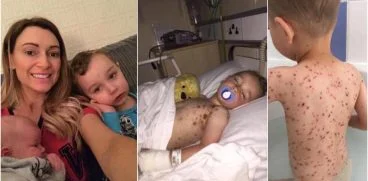 De ce NU trebuie sa-i dai ibuprofen copilului cu varsat de vant! Academia de Pediatrie avertizeaza | Demamici.ro