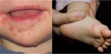 Totul despre boala mana-gura-picior. Care sunt simptomele si cum se trateaza | Demamici.ro
