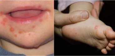 Totul despre boala mana-gura-picior. Care sunt simptomele si cum se trateaza | Demamici.ro