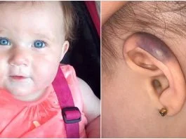 Fetita de 1 an, atacata de un pescarus. Micuta s-a ales cu o ureche vanata | Demamici.ro