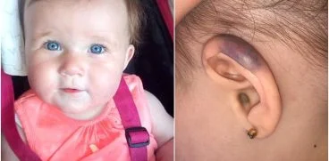 Fetita de 1 an, atacata de un pescarus. Micuta s-a ales cu o ureche vanata | Demamici.ro