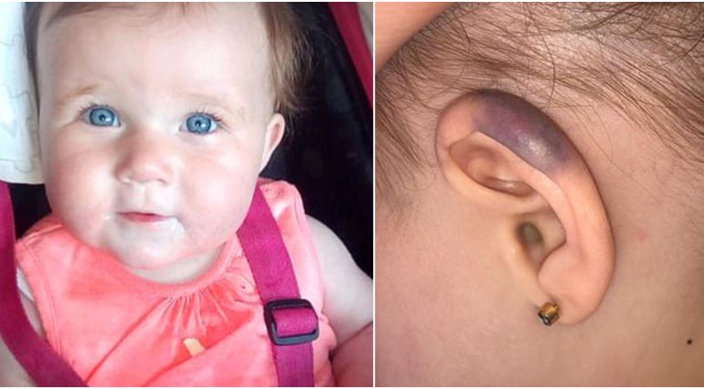 Fetita de 1 an, atacata de un pescarus. Micuta s-a ales cu o ureche vanata | Demamici.ro