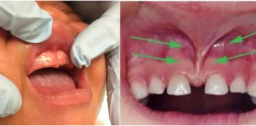 Ce este frenul labial si cum influenteaza dezvoltarea copilului | Demamici.ro