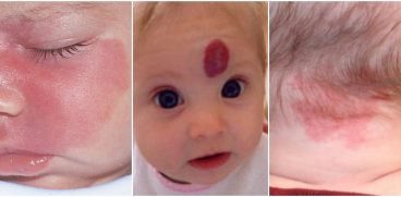 Semnele din nastere pe pielea copilului. Dispar de la sine? Specialistii explica | Demamici.ro