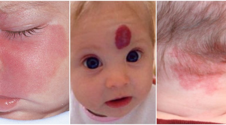 Semnele din nastere pe pielea copilului. Dispar de la sine? Specialistii explica | Demamici.ro