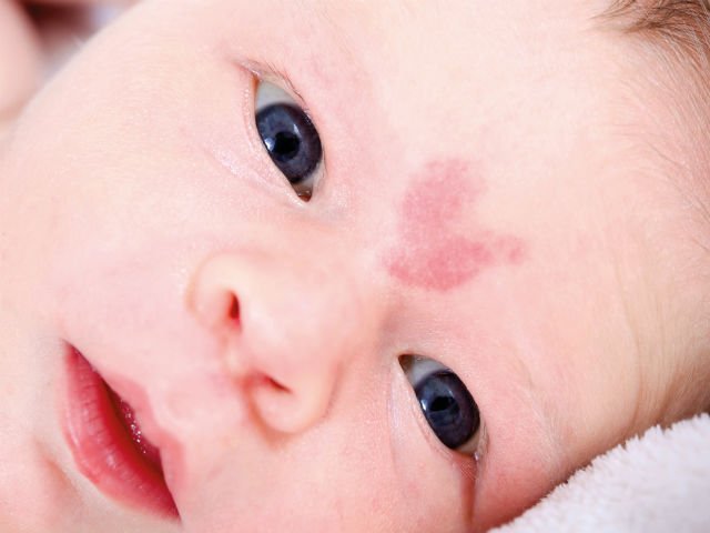 Ce indica semnele din nastere pe pielea copilului.