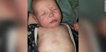 Mama unui copil bolnav de rujeola rupe tacerea: „Comunitatea a dezamagit” | Demamici.ro