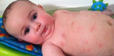 Dermatita atopica la copii. Care sunt simptomele si cum se trateaza | Demamici.ro