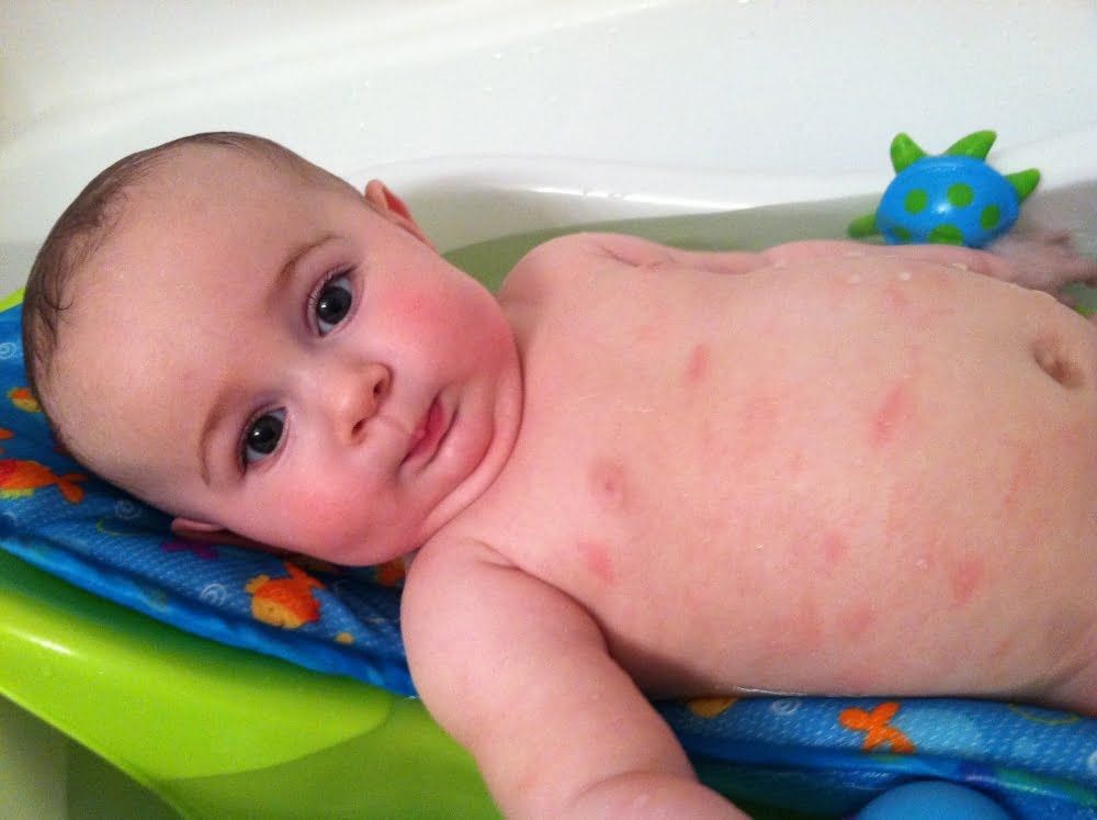 Dermatita Atopica La Copii Care Sunt Simptomele Si Cum Se Trateaza