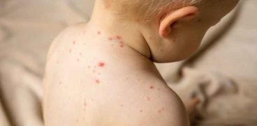 Totul despre rujeola. Care sunt simptomele si cum se poate preveni | Demamici.ro