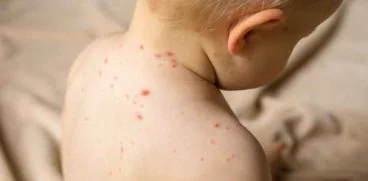 Totul despre rujeola. Care sunt simptomele si cum se poate preveni | Demamici.ro