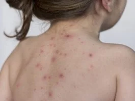 Totul despre varicela (varsat de vant). Care sunt simptomele si cum se trateaza | Demamici.ro