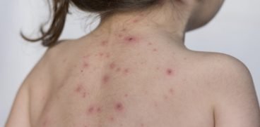 Totul despre varicela (varsat de vant). Care sunt simptomele si cum se trateaza | Demamici.ro