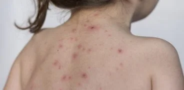 Totul despre varicela (varsat de vant). Care sunt simptomele si cum se trateaza | Demamici.ro