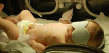 Icterul la nou-nascuti. Cand exista motive de ingrijorare? | Demamici.ro