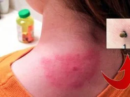 Copilul meu a fost muscat de o capusa. Ce fac? | Demamici.ro