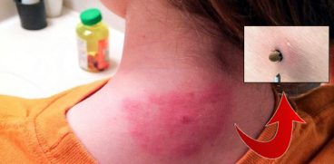 Copilul meu a fost muscat de o capusa. Ce fac? | Demamici.ro