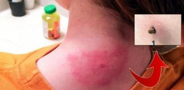 Copilul meu a fost muscat de o capusa. Ce fac? | Demamici.ro