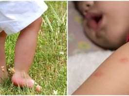 Ce trebuie sa faci daca copilul a fost intepat de insecte | Demamici.ro