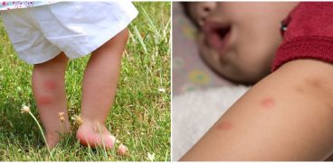 Ce trebuie sa faci daca copilul a fost intepat de insecte | Demamici.ro