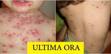 207 cazuri noi de rujeola, in ultima saptamana. Care sunt cele mai afectate judete | Demamici.ro