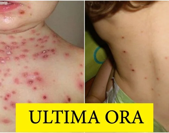 207 cazuri noi de rujeola, in ultima saptamana. Care sunt cele mai afectate judete | Demamici.ro