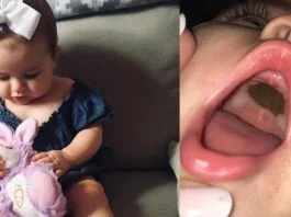 O mama si-a dus fiica de urgenta la doctor din cauza unei pete negre de pe cerul gurii | Demamici.ro