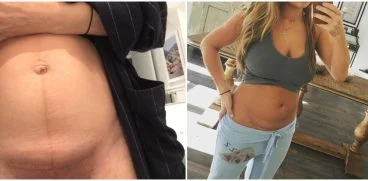 Fotografii cu operatiile de cezariana ale vedetelor. Mamicile celebre le-au facut publice fara jena | Demamici.ro