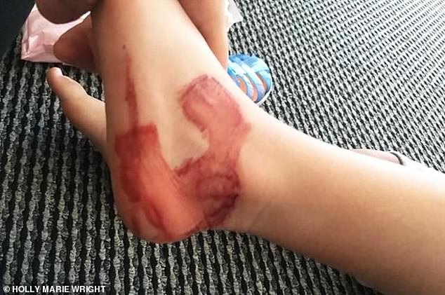 O fetiță de trei ani are răni groaznice la picioare